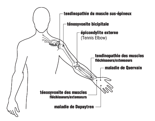 Figure 3 - Sièges les plus fréquents des troubles tendineux