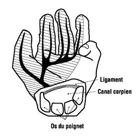 CCHST: Syndrome du canal carpien